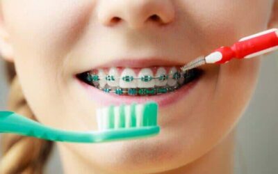 Cómo cepillarse correctamente los dientes con «brackets»