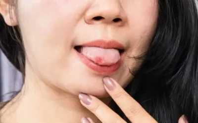¿Cómo aliviar y curar una quemadura en la lengua?