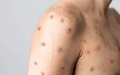 OMS declara mpox como emergencia internacional nuevamente, ¿qué hay que tener en cuenta?