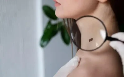 ¿Por qué aparecen las verrugas en el cuello y cómo eliminarlas?