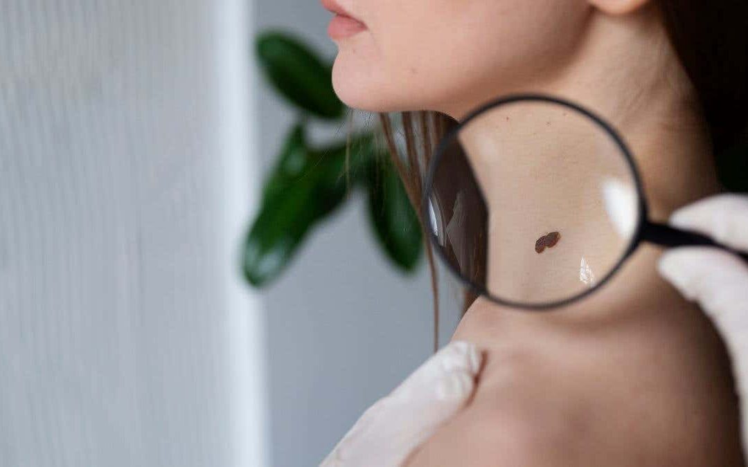 ¿Por qué aparecen las verrugas en el cuello y cómo eliminarlas?